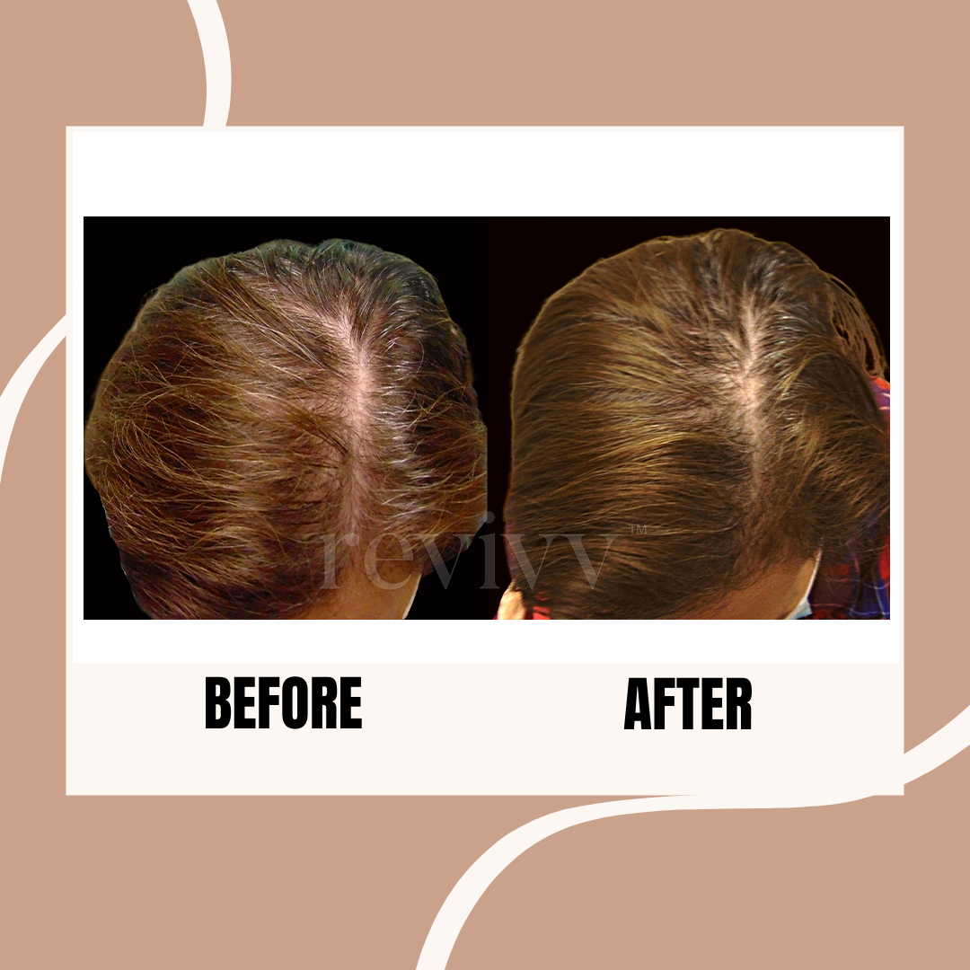 After using Revivv® for 2 months