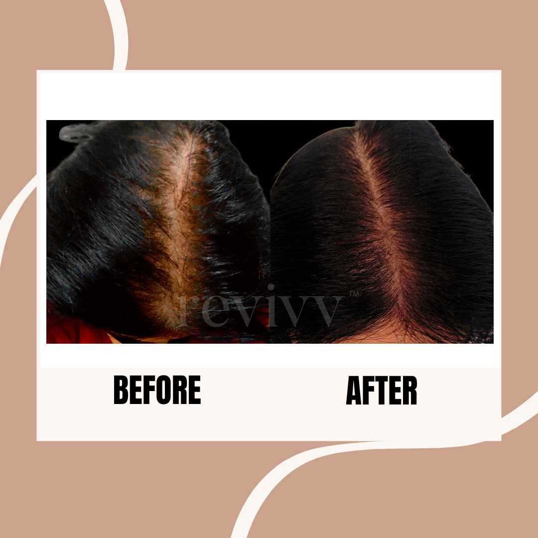 After using Revivv® for 2 months