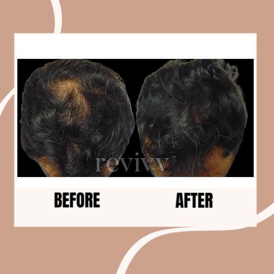 After using Revivv® for 2 months